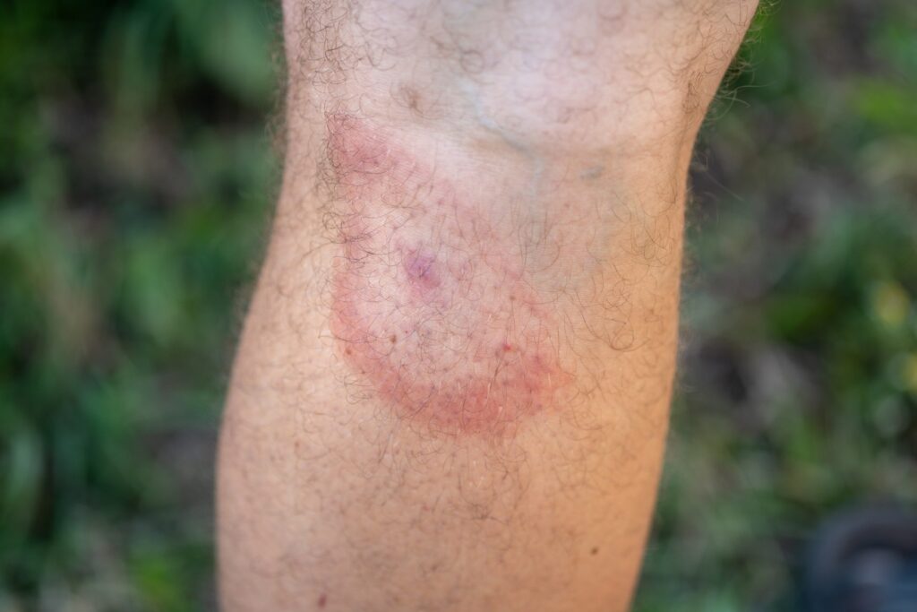 Redness around a tick bite in the hollow of the knee